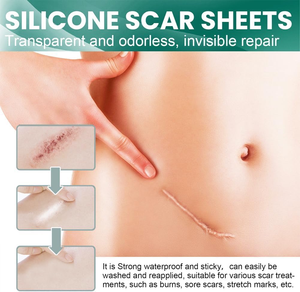SKY-TOUCH Silicone Scar Sheets,Extra Long Scar Sheets for C-Section, Tummy Tuck, Keloid, and Surgical Scars - Reusable Medical Grade Silicone Scar Tape(4 x 150cm/1 Roll)
